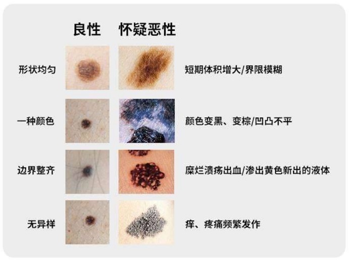 良性痣的图片区别图片